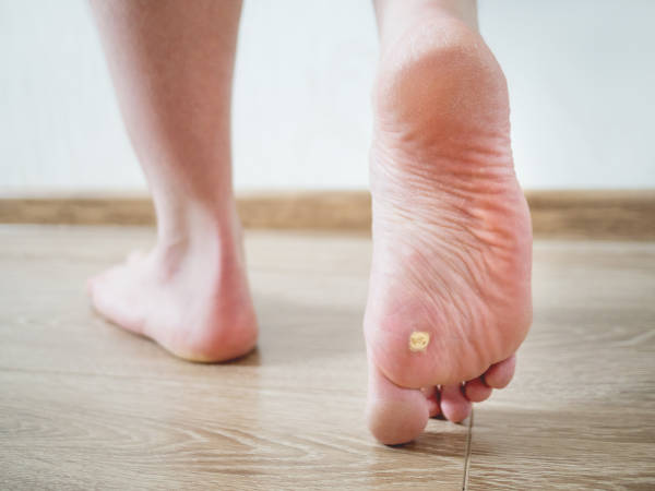 foot wart treatment and removal in Chandler, AZ | Gilbert Podiatrist | Chandler Podiatrist