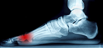 Mortons' neuroma treatment in the Maricopa County, AZ: Chandler(Dobson Ranch, Kiwanis Park, Tempe, Ocotillo, Sun Lakes, Goodyear Village, Guadalupe, Ahwatukee, Mountain Park Ranch) and Gilbert (The Islands, Val Vista Lakes, Superstition Springs, Reed Park, Power Ranch, Mesa, Queen Creek, Eastmark, Kleinman Park Neighborhood, Lower Santan Village) areas