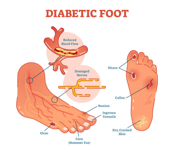 diabetic foot care