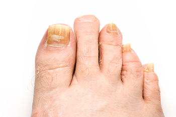 Fungal toenails diagnosis and treatment in the Maricopa County, AZ: Chandler(Dobson Ranch, Kiwanis Park, Tempe, Ocotillo, Sun Lakes, Goodyear Village, Guadalupe, Ahwatukee, Mountain Park Ranch) and Gilbert (The Islands, Val Vista Lakes, Superstition Springs, Reed Park, Power Ranch, Mesa, Queen Creek, Eastmark, Kleinman Park Neighborhood, Lower Santan Village) areas