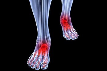 Xray of Arthritic foot and ankle treatment