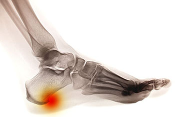 Heel spurs treatment in the Maricopa County, AZ: Chandler(Dobson Ranch, Kiwanis Park, Tempe, Ocotillo, Sun Lakes, Goodyear Village, Guadalupe, Ahwatukee, Mountain Park Ranch) and Gilbert (The Islands, Val Vista Lakes, Superstition Springs, Reed Park, Power Ranch, Mesa, Queen Creek, Eastmark, Kleinman Park Neighborhood, Lower Santan Village) areas