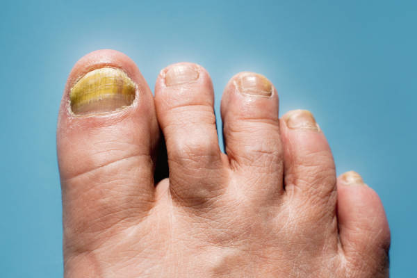 toenail fungus symptoms | Chandler Podiatrist | Gilbert Podiatrist
