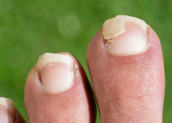 Set of toes where one of the nails is broken