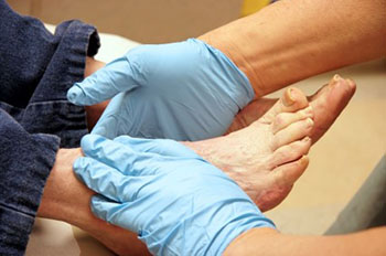Diabetic foot treatment and care, Diabetic Ulcers Treatment & Management in the Maricopa County, AZ: Chandler(Dobson Ranch, Kiwanis Park, Tempe, Ocotillo, Sun Lakes, Goodyear Village, Guadalupe, Ahwatukee, Mountain Park Ranch) and Gilbert (The Islands, Val Vista Lakes, Superstition Springs, Reed Park, Power Ranch, Mesa, Queen Creek, Eastmark, Kleinman Park Neighborhood, Lower Santan Village) areas