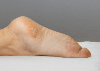 Plantar wart close up on the bottom of a female foot heel