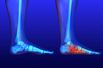 Flat feet and Fallen Arches treatment, Flatfoot Deformity Treatment in the Maricopa County, AZ: Chandler(Dobson Ranch, Kiwanis Park, Tempe, Ocotillo, Sun Lakes, Goodyear Village, Guadalupe, Ahwatukee, Mountain Park Ranch) and Gilbert (The Islands, Val Vista Lakes, Superstition Springs, Reed Park, Power Ranch, Mesa, Queen Creek, Eastmark, Kleinman Park Neighborhood, Lower Santan Village) areas