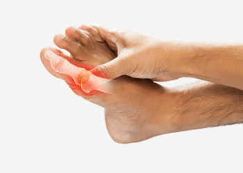 a foot with Gout condition 