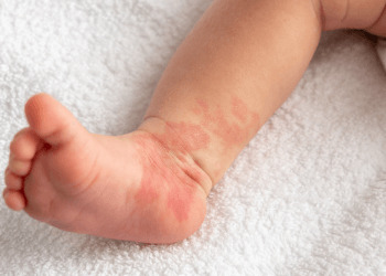 red birthmark on the leg of newborn baby
