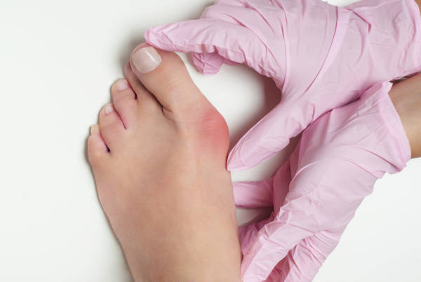 bunions | bunion surgery vs conservative treatment | Chandler podiatrist | Gilbert podiatrist