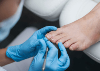 The podologist cleans the patient's Toenail Fungus using a curette tool