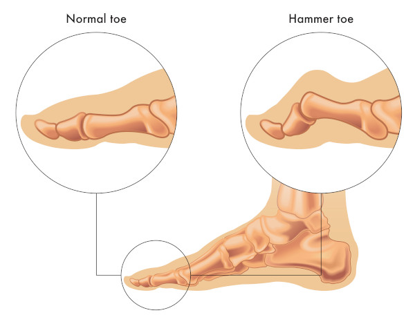 hammer toe | hammertoe myths | hammertoe facts