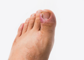 Close up of ingrown toenail is Inflamed fingernails