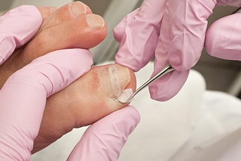 Ingrown toenails treatment in the Maricopa County, AZ: Chandler(Dobson Ranch, Kiwanis Park, Tempe, Ocotillo, Sun Lakes, Goodyear Village, Guadalupe, Ahwatukee, Mountain Park Ranch) and Gilbert (The Islands, Val Vista Lakes, Superstition Springs, Reed Park, Power Ranch, Mesa, Queen Creek, Eastmark, Kleinman Park Neighborhood, Lower Santan Village) areas