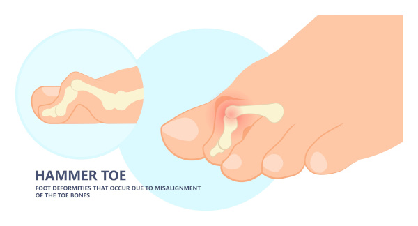 hammer toe treatment