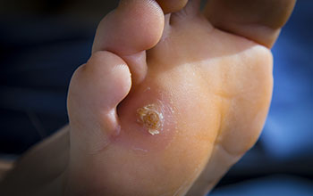 Corns and Calluses treatment in the Maricopa County, AZ: Chandler(Dobson Ranch, Kiwanis Park, Tempe, Ocotillo, Sun Lakes, Goodyear Village, Guadalupe, Ahwatukee, Mountain Park Ranch) and Gilbert (The Islands, Val Vista Lakes, Superstition Springs, Reed Park, Power Ranch, Mesa, Queen Creek, Eastmark, Kleinman Park Neighborhood, Lower Santan Village) areas