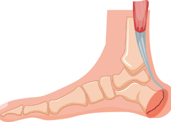 Skeleton struck of the foot having Sever's disease