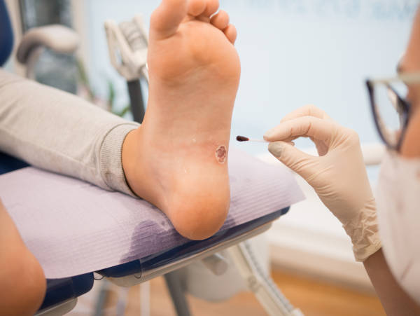 wart treatment and removal