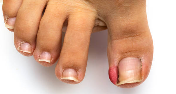 ingrown toenail | Chandler podiatrist | Gilbert Podiatrist