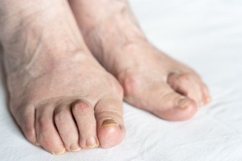 Hammer Toe Treatment