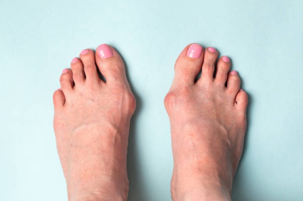 Bunions